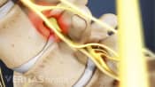 Degenerative scoliosis in the vertebra.