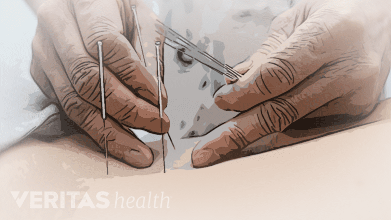 An image showing acupuncture needles being inserted in the low back area.