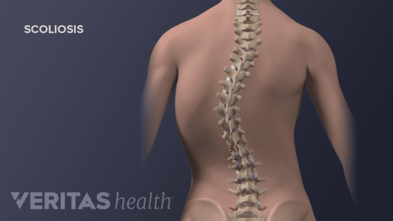 Posterior view of the adolescent spine showing thoracic scoliosis.