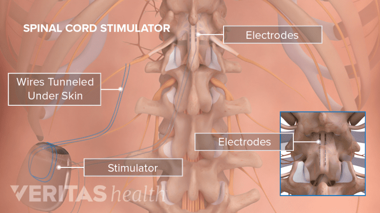 parts of spinal cord stimulator