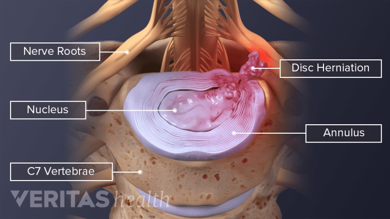 Top down labeled view of a C6-C7 disc herniation.