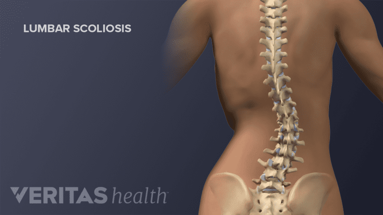 Illustration showing degenerative scoliosis.