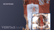 Medical illustration of a microtear is the muscles of the lumbar spine.