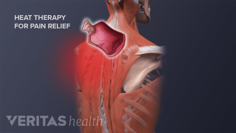 Illustration of posterior view of torso showing heat pack icon on the neck.
