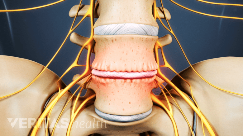 A degenerated L4-L5 spinal disc.