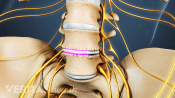 Anterior view of the lumbar spine showing healing over the bone graft inserted for a spinal fusion.