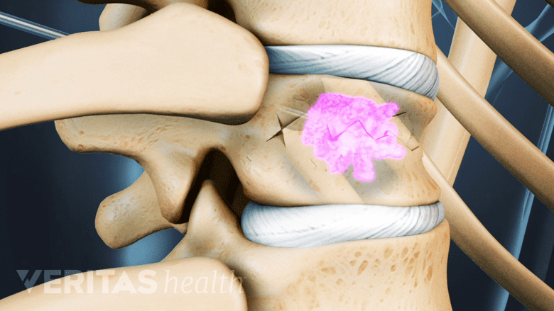 Illustration showing vertebra with  fracture lines and pink highlight on it.