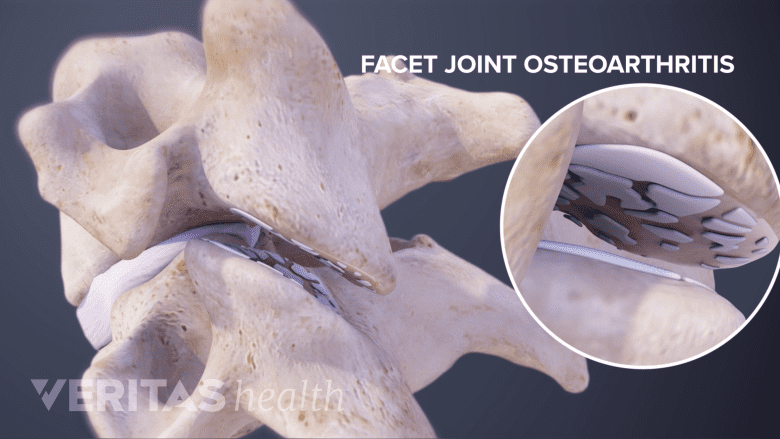 Illustration showing cervoical vertebrae with facet joints and a inset showing osteoarthritis.