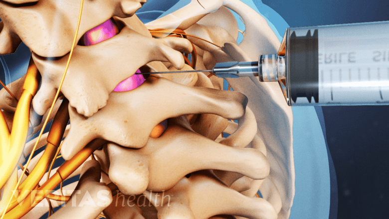 Illustration showing cervical epidural injection.