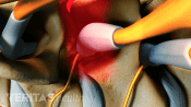 Medical illustration of nerve impingement in the cervical spine