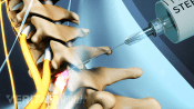 Selective nerve root block being injected into the cervical spine
