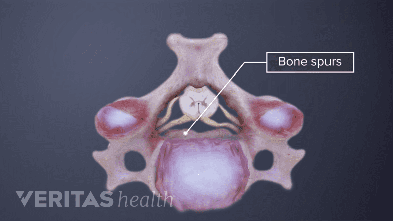 Illustration showing cervical bone spurs.