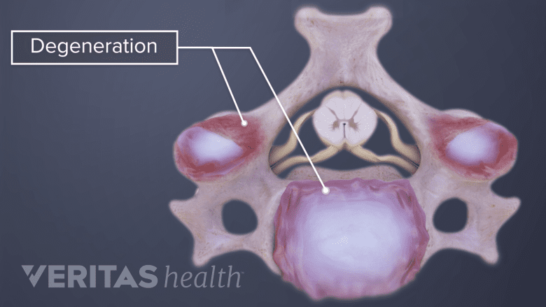 Illustration showing degeneration in the cervical disc.