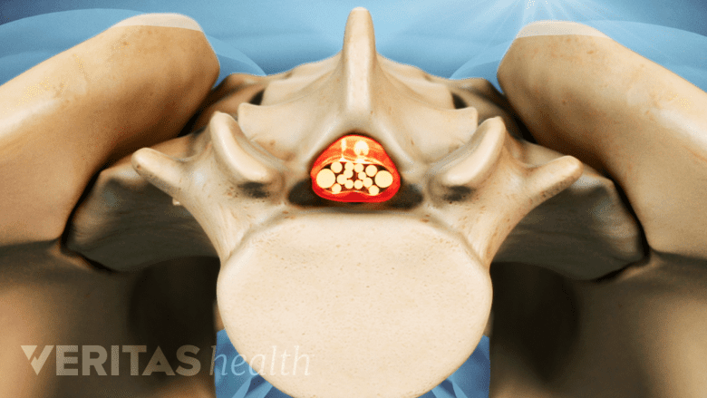 Illustration showing lumbar spinal canal.