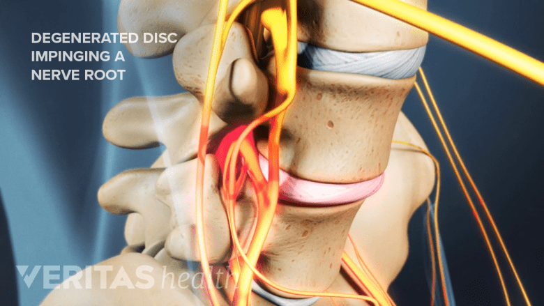 Illustration showing lumbar degenerated disc highlighted in red.