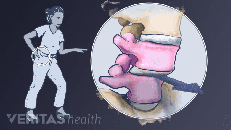 A woman holding her back and incet showing one vertebra slipped over the other.