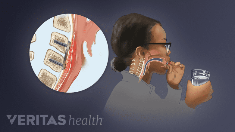 Illustration showing difficulty in swallowing.