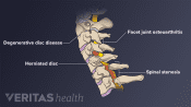 Medical illustration showing conditions that may occur in the cervical spine. Degenerative disc disease, facet joint osteoarthritis, herniated disc, and spinal stenosis are labeled.