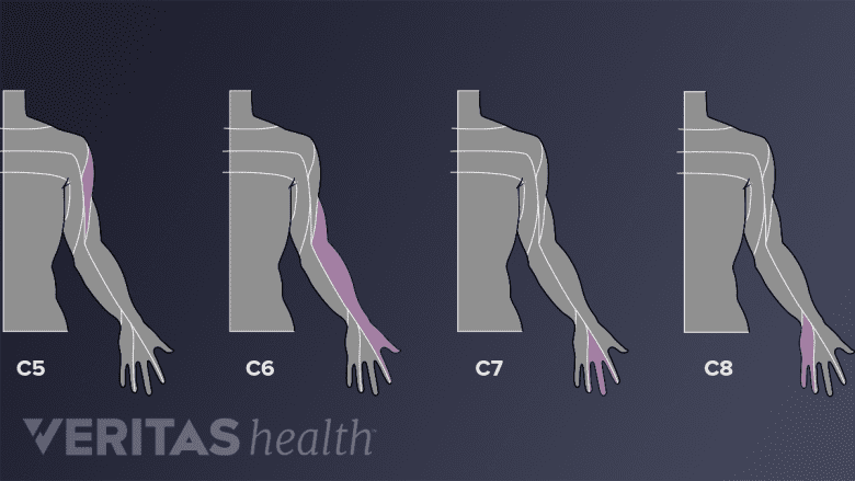 Cervical dermatomes C5, C6, C7, and C8.