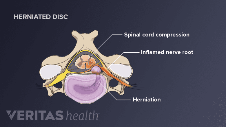 Illustration of cervical herniated disc.