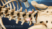 Injection of anesthetic into facet joints