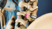 Facet joint injection
