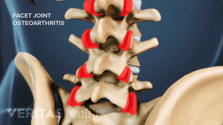 Illustration showing lumbar vertebra with facet joints highlighted in red.