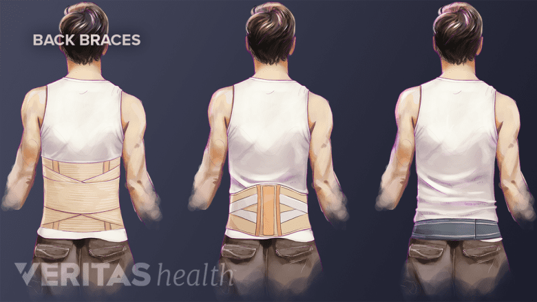 An illustration showing different types of back braces.