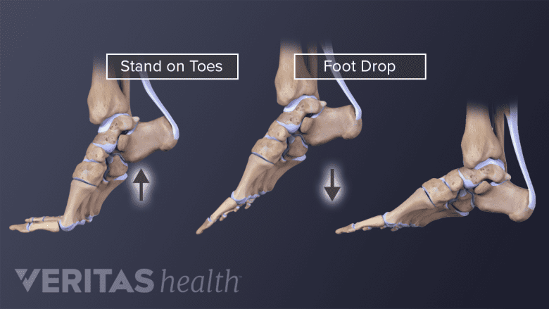 Illustration of anatomy of feet showing foot drop.
