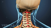 Posterior view of the cervical spine with radiculopathy.