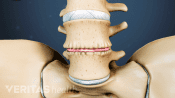Disc degeneration in the spine can sometimes be caused by or accelerated by diabetes.