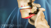 Profile view of the lumbar spine showing grade 4 spondylolisthesis of the L5 over the sacrum.