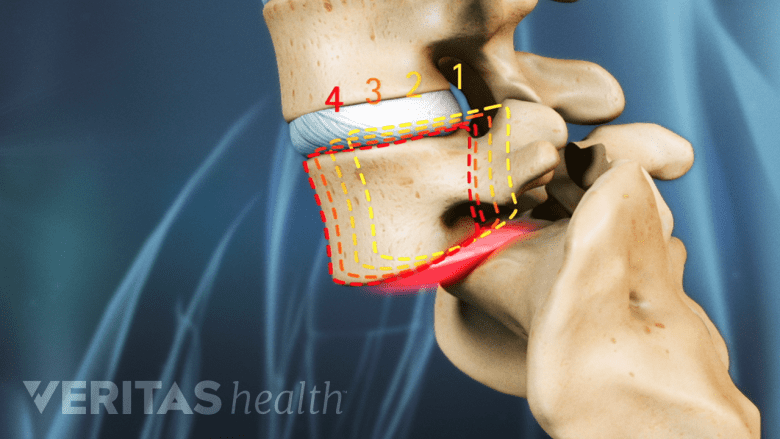 Isthmic spondylolisthesis of the L5-S1 spinal segemnt.
