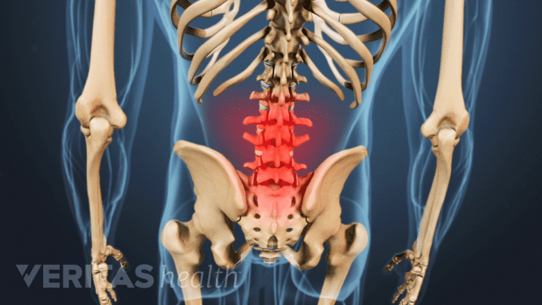 Posterior view of the lumbar spine highlighting pain.