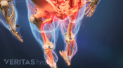 Medical illustration of the lower body, with the legs and hips highlighted in red to indicate pain, numbness or tingling.
