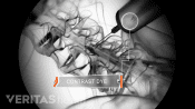 X-ray view of contrast dye being injected into the lumbar spine.