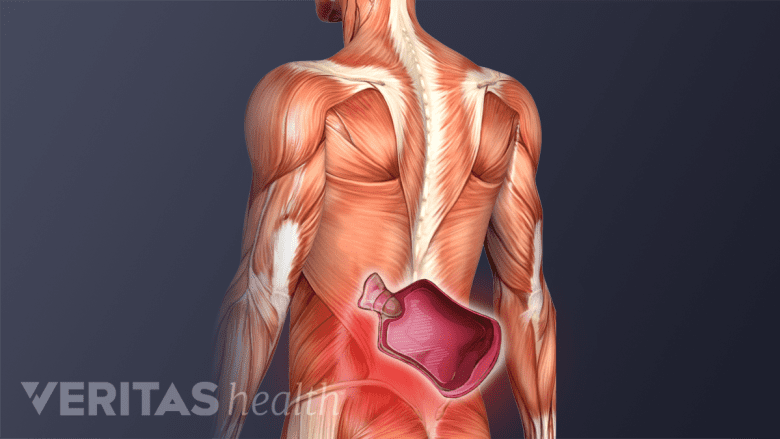 Illustration showing postrior torso with a heat pack in the low back.