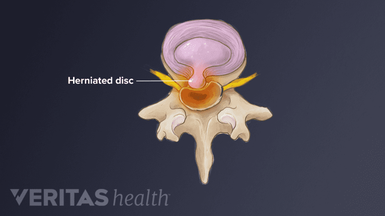 Illustration showing lumbar herniated disc.