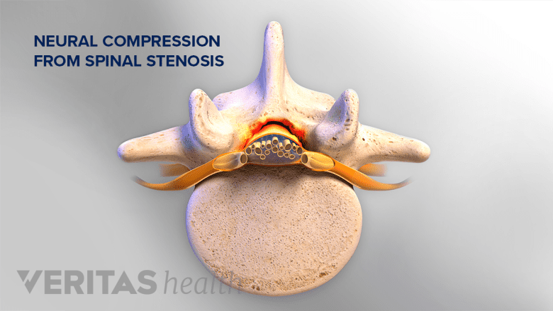 Illustration showing lumbar spinal stenosis.