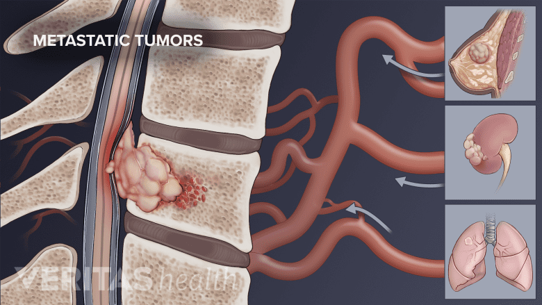 A medical illustration showing a metastatic tumor in the spinal column.