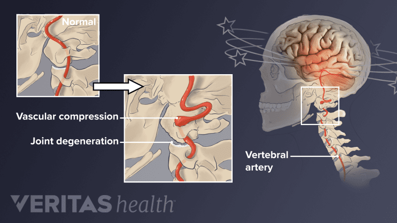 Diagram of issues that can happen to the cervical arteries.