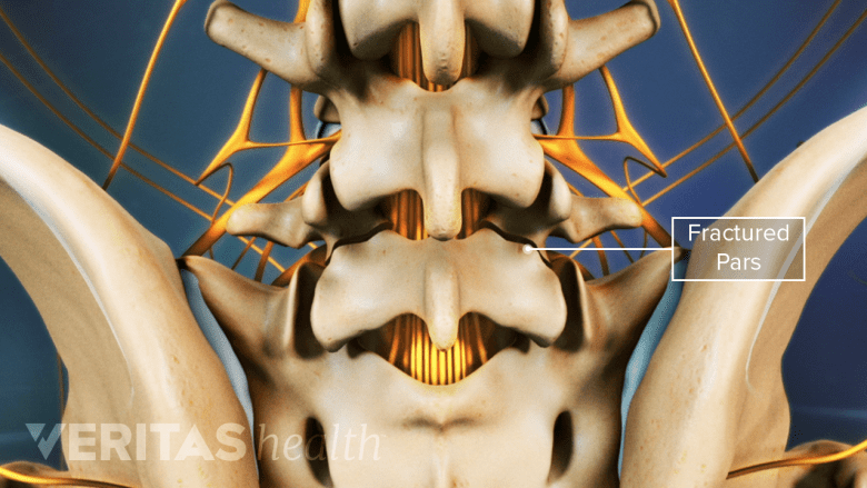 Illustration showing fractured pars interarticularis in the lumbar spine.
