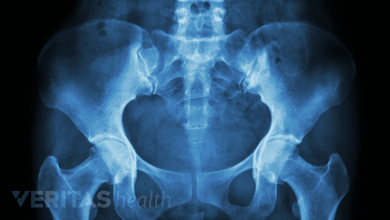 Illustration showing x-ray of pelvis and lumbar region.