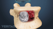 Pmma injection during kyphoplasty procedure