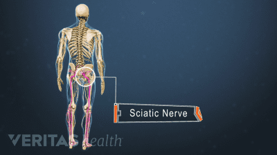 Medical illustration of a skeleton. The sciatic nerve is labeled and highlighted in red indicating pain, numbness or tingling.