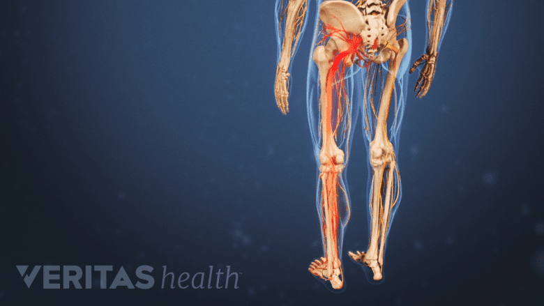 Posterior view of skeleton and nerves with a pain path in the left leg highlighted.