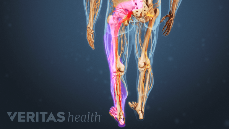 Posterior view of path of radiating pain down the leg