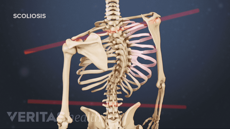 Illustration showing curved spine indicating scoliosis.