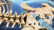 Posterior view of the pelvis with injection into the SI joint