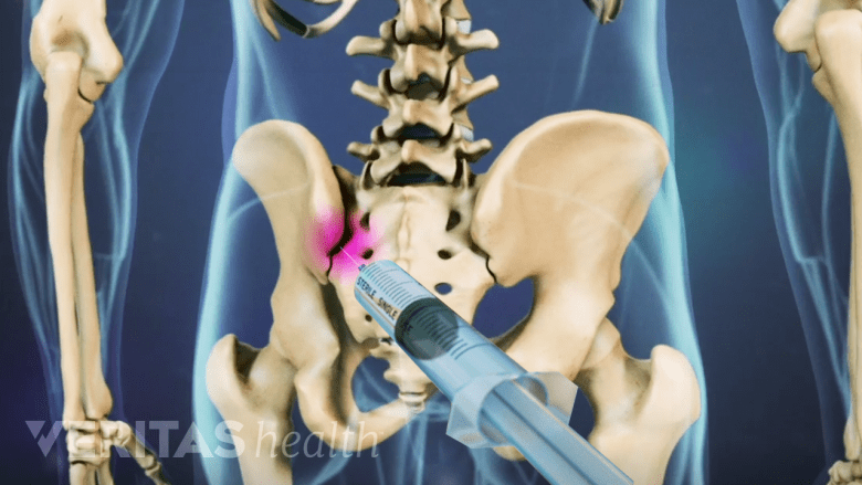 Illustration showing pelvis with SI joint highlighted in pink and a needle inserted into the joint.